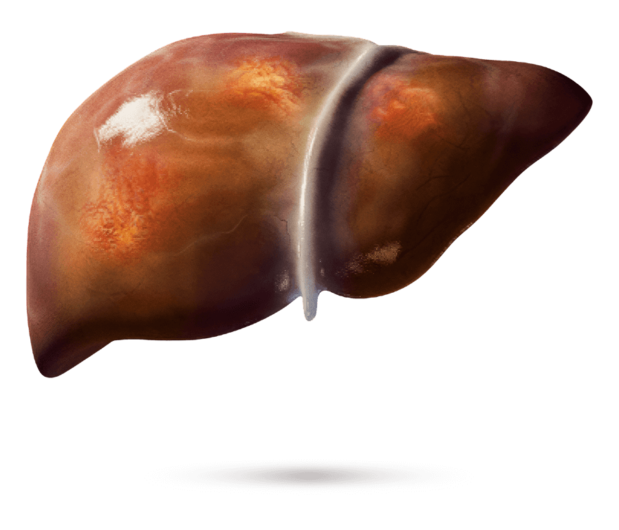Illustration médicale d’un foie avec fibrose apparente.
