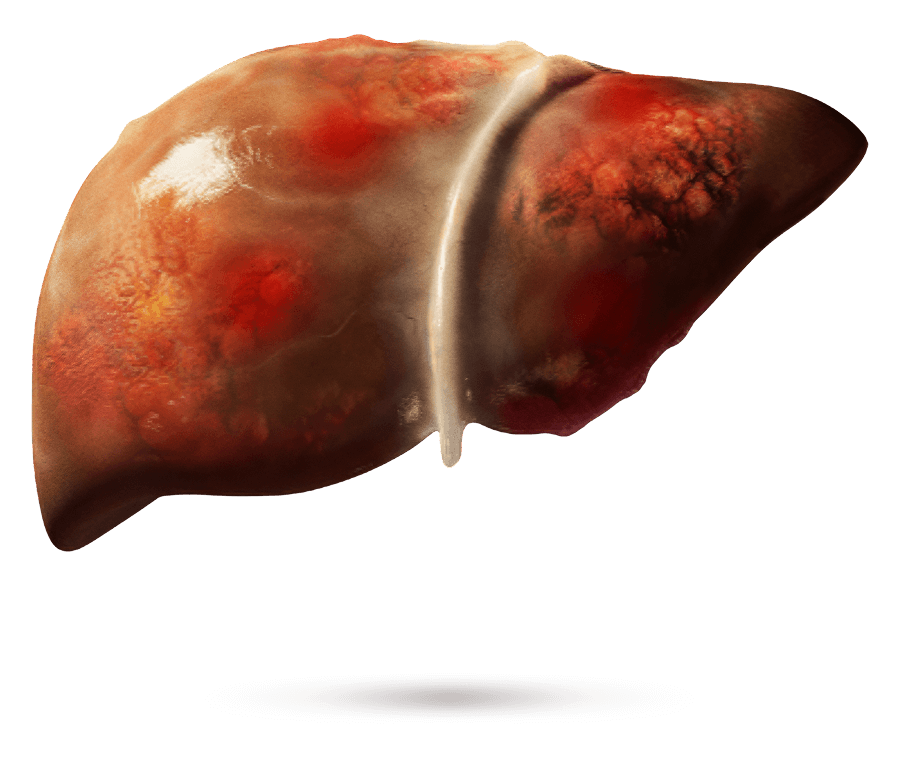Illustration médicale d’un foie avec fibrose apparente.