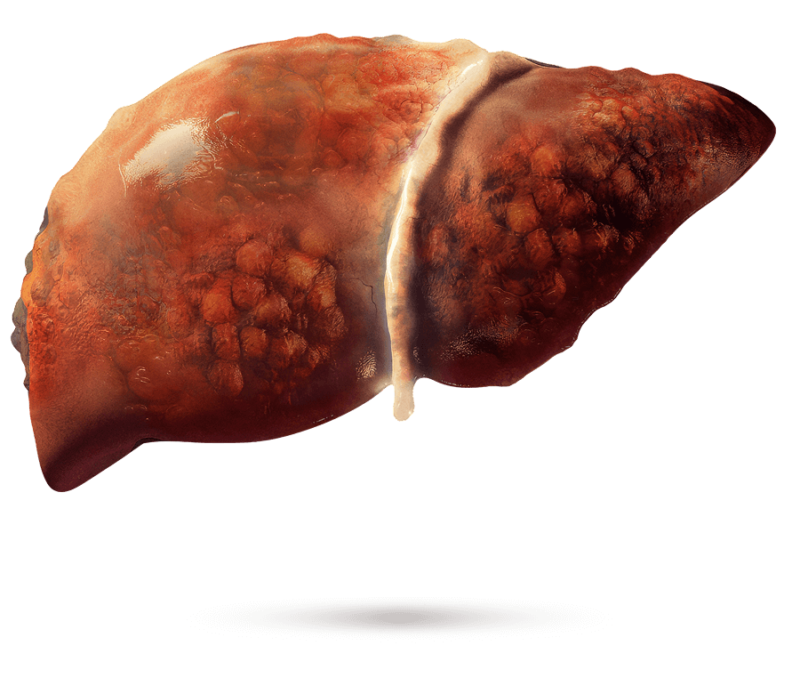 Illustration médicale d’un foie avec fibrose apparente.