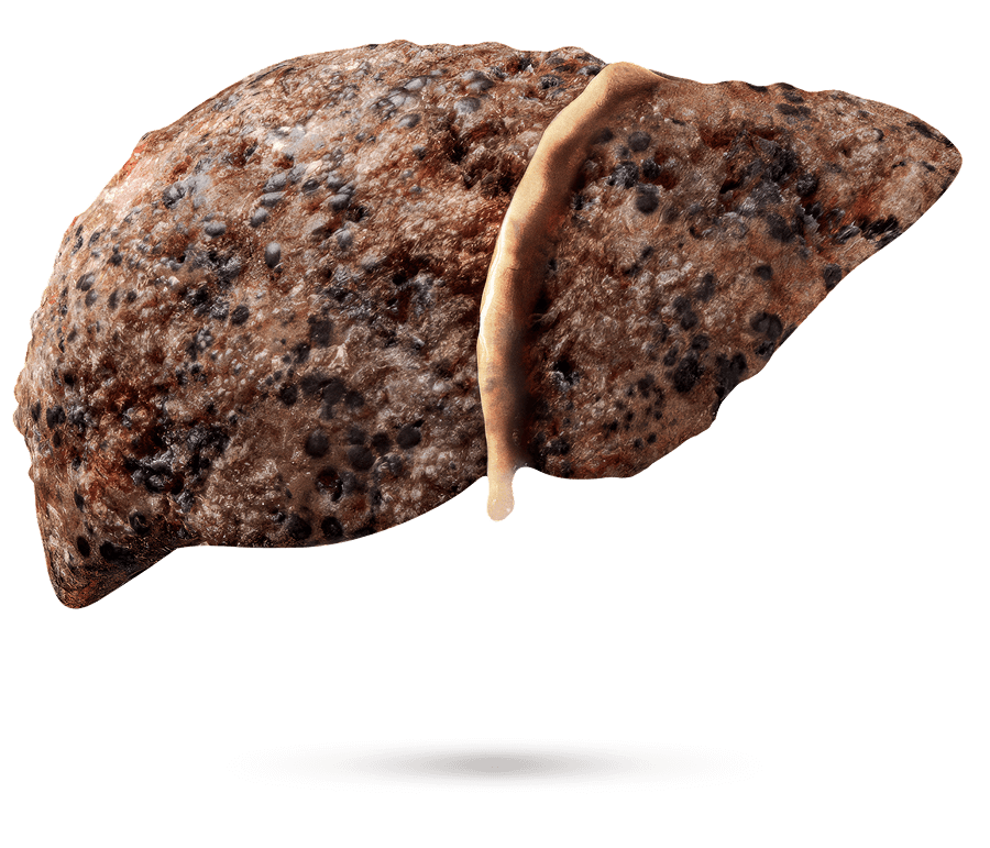 Illustration médicale d’un foie avec fibrose apparente.